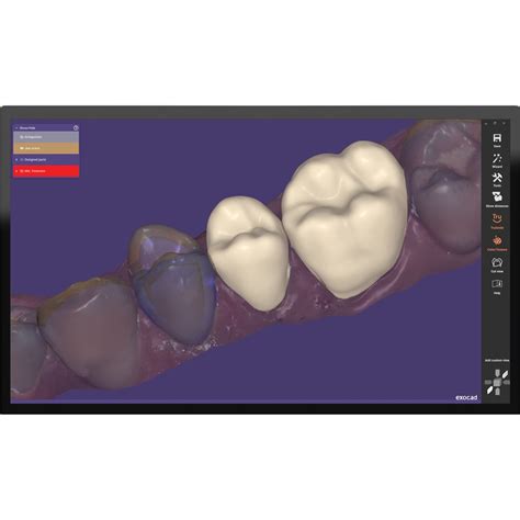 Ex Mod F Exocad Dentalcad Provision Module Flex Pacific Dental