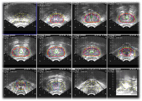 Cáncer de Próstata Radioterapia HM