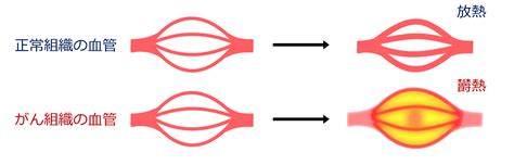 ハイパーサーミア（がん温熱療法機器）のご紹介｜診療科・部門のご案内｜社会医療法人蘇西厚生会 松波総合病院