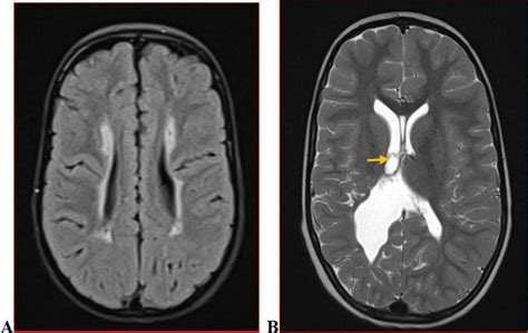 Typical Pvl A With Symmetrical Flair Hyperintense Periventricular Rim Download Scientific