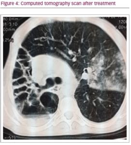 Delayed Diagnosis of Kartagener Syndrome in a Fertile Young Man – An ...