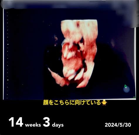 14w3d 妊婦健診 まさかのハイリスク？前置胎盤 不妊治療をやめた翌月に自然妊娠！