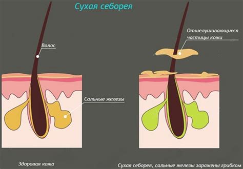 Суха себорея: діагностика, симптоми, причини появи, методи лікування