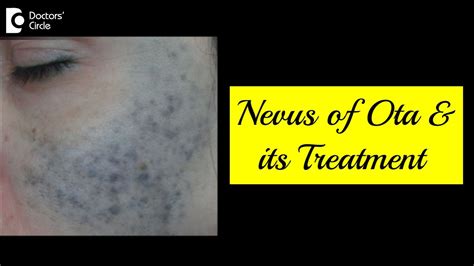 Nevus Of Otawhat Is It And How Is It Treated Skin Pigmentation Dr