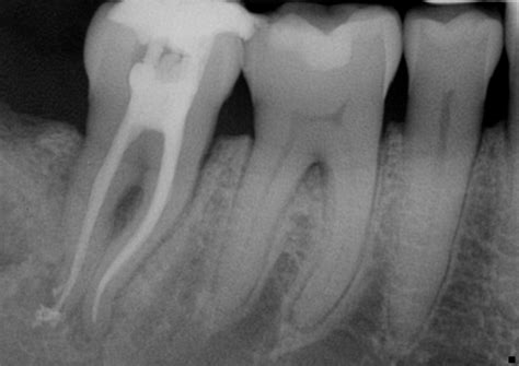 Tooth Fracture After Root Canal