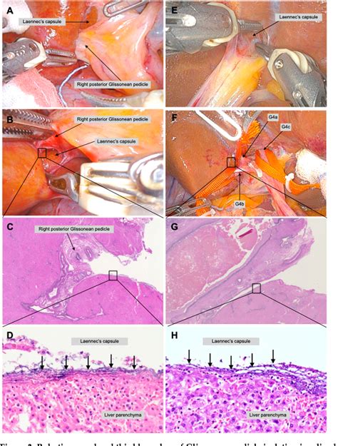 Figure From Glissonean Pedicle Isolation Focusing On The Laennecs