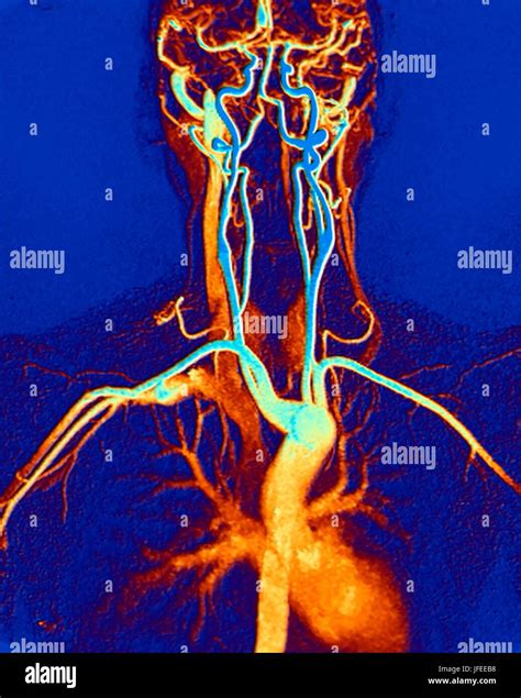 Arterias Carotidas Del Cuello Fotos E Imágenes De Stock Alamy