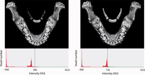 Hyoid Bone Development An Assessment Of Optimal Ct Scanner Parameters And Three‐dimensional