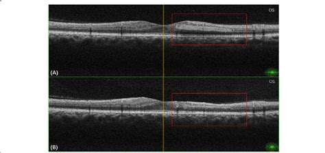 A Oct Scan Of The Left Eye Showing Hyper Reflective Band In The Inner