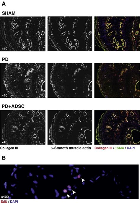 Intratunical Injection Of Human Adipose Tissue Derived Stem Cells