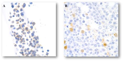 Bone Marrow Biopsy The Blasts Are Variably Positive For Cd A And