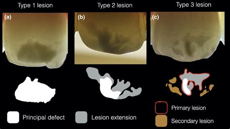 The Use Of Transillumination In Mapping Demarcated Enamel Opacities In