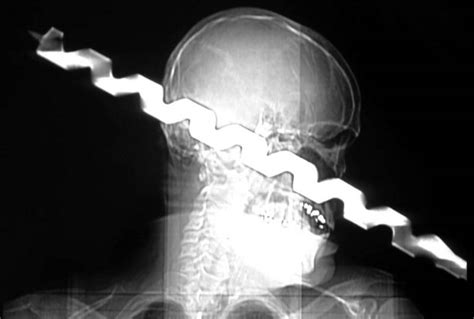 Drill Bit Accident Survivors Tale On Tv