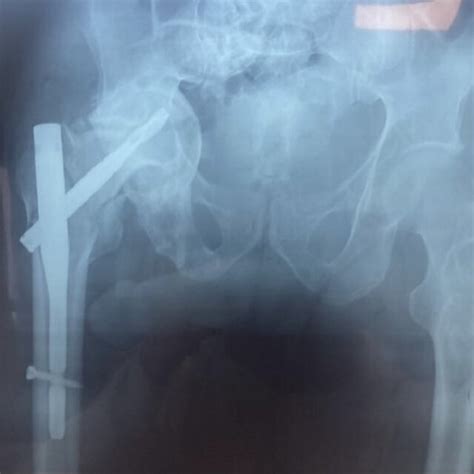 Anteroposterior radiograph after 8 months of surgery showing fracture... | Download Scientific ...