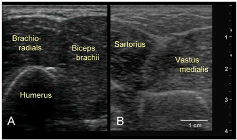 Brachial Vein Ultrasound