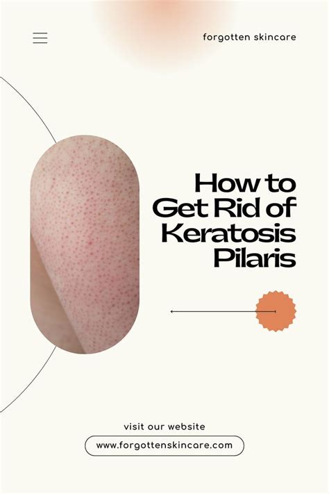 How To Get Rid Of Keratosis Pilaris Fast Artofit