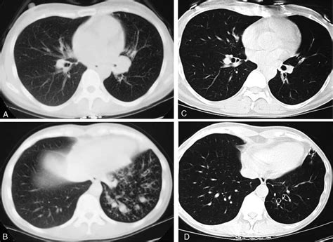 Ct Scans Chest Double Contour And Signet Ring Signs Are Present In
