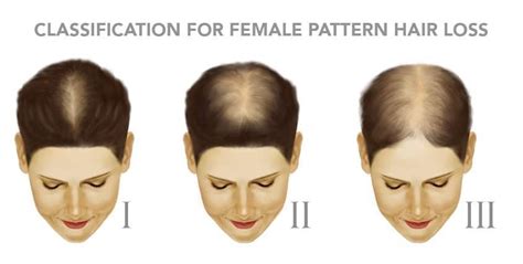 Woman Hair Loss Classification Premier Clinic Cn