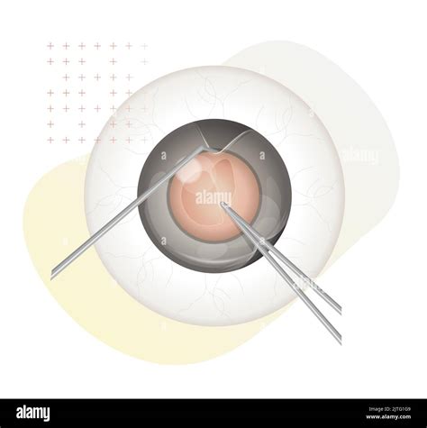 Human Eye Cataract Procedure Illustration As Eps 10 File Stock Vector Image And Art Alamy