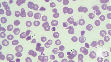 Hemoglobin Sc Disease Blood Smear