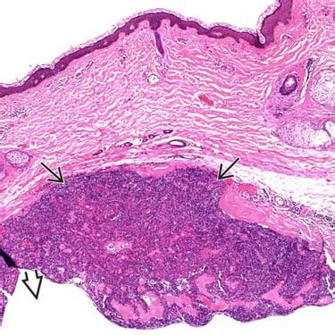 Hidradenoma Histology