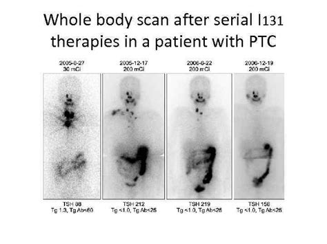 Dr Nodelman Marina Thyroid Cancers 1