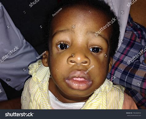 Treacher Collins Syndrome 8 รายการ ภาพ ภาพสต็อกและเวกเตอร์ Shutterstock