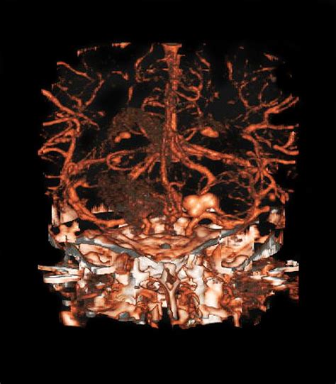 Berry Aneurysm Angiogram Photograph By Du Cane Medical Imaging Ltd