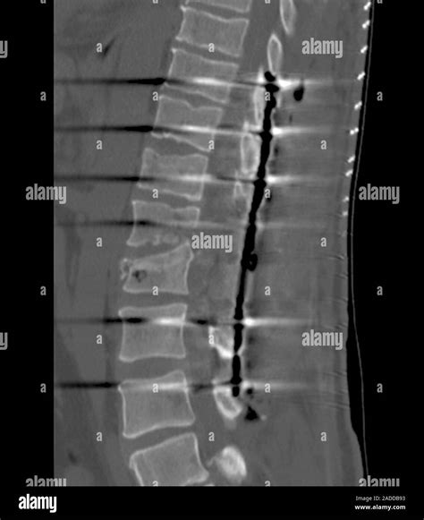 Spinal Fusion Surgery For Broken Back Sagittal Computed Tomography Ct