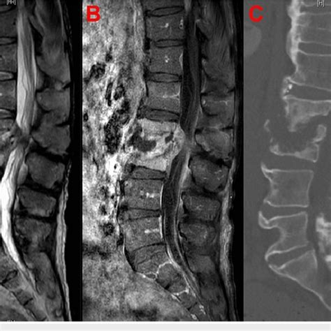 A Midsagittal T2 Weighted MRI Without Contrast B Midsagittal