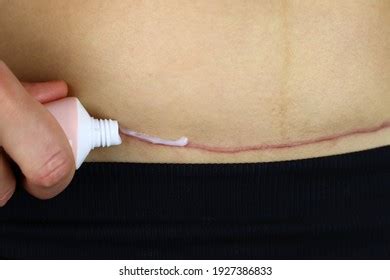 106 Hysterectomy scar Images, Stock Photos & Vectors | Shutterstock