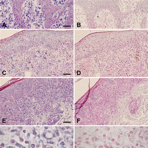 In Situ Hybridization For Mir 21 In Mycosis Fungoides Intense Mir 21