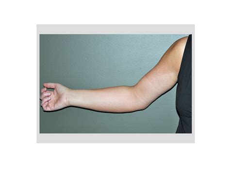 arm-swelling-lymphedema-after-armlift-dr-barry-eppley-indianapolis