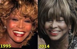 Tina Turner Plastic Surgery Before And After - Latest Plastic Surgery ...