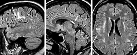 Lyme Neuroborreliosis Manifestations Of A Rapidly Emerging Zoonosis