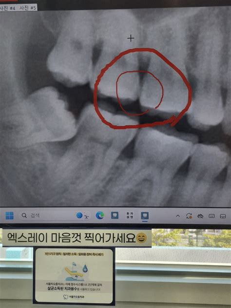 치지직 X 왼쪽 사랑니 위 아래로 뽑고 별로 안 아프면 정상임 치지직 에펨코리아