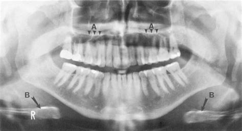 Radiology Lecture 06 Panoramic Landmarks Flashcards Quizlet