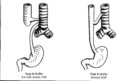 Tracheoesophageal Fistula