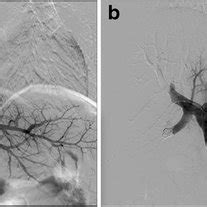 A Pre Right Portal Vein Embolization Venogram B Post Right Anterior