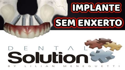 Veja como é feito o IMPLANTE DENTAL SEM ENXERTO YouTube