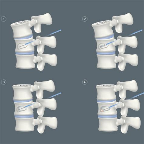 Kyphoplasty Vertebroplasty And Sacroplasty Minneapolis Vein Center