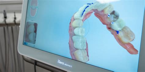 Unlocking The Future Of Dental Implants With Jackerman 3D Revolutionizing Oral Surgery