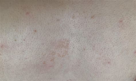 Drydiscolored Follicles In Small Clusters On Chest I Deal Tinea