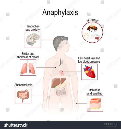 Anaphylaxis Serious Allergic Reaction That May Stock Vector (Royalty Free) 1246940149 | Shutterstock