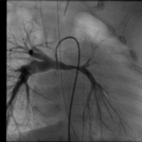 Figure E1 Pulmonary Artery Angiogram Demonstrating Left Pulmonary Download Scientific Diagram