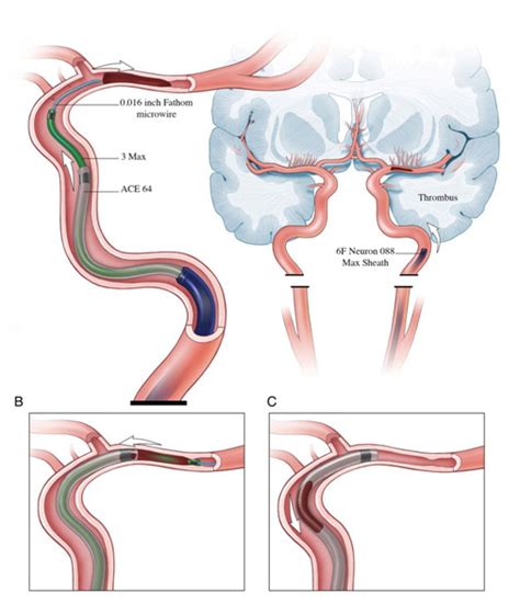 Acute Ischemic Stroke Varicose Veins Vascular Surgeon Stroke