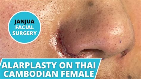 Alarplasty Nostril Reduction On Thai Cambodian Female Dr Tanveer