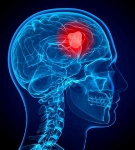 Brain Cancer Symptoms | MedGuidance