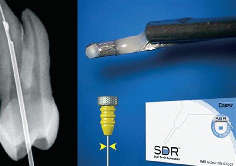 Broken Instrument Removal The Endodontic Challenge 246 Dentistry Today Ce