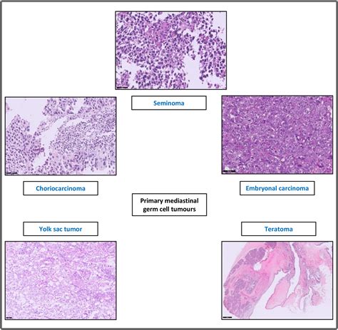 Primary Germ Cell Tumours Of The Mediastinum A Review With Emphasis On